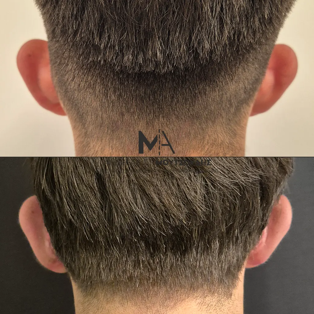 Ωτοπλαστική αληθινές φωτογραφίες Πριν και Μετά