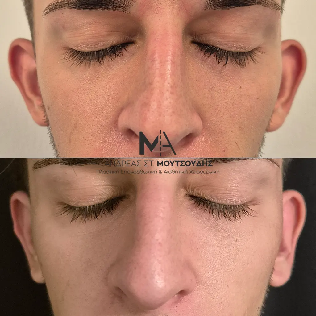 Ωτοπλαστική αληθινές φωτογραφίες Πριν και Μετά