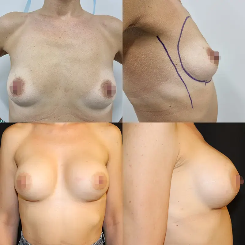 Αύξηση στήθους Πριν και Μετά