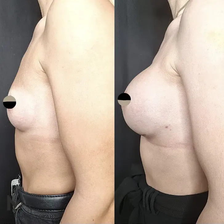 Αύξηση στήθους Πριν και Μετά