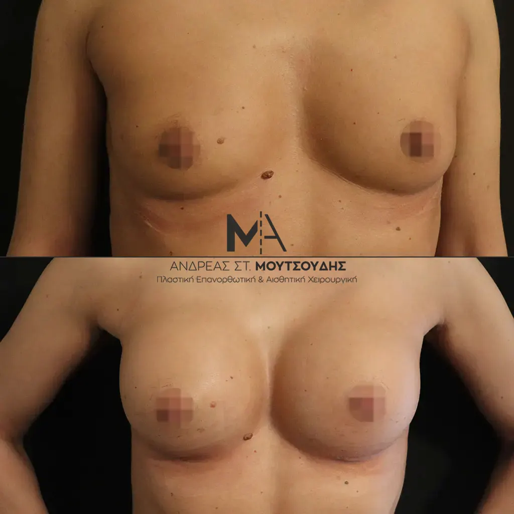Αύξηση στήθους Πριν και Μετά