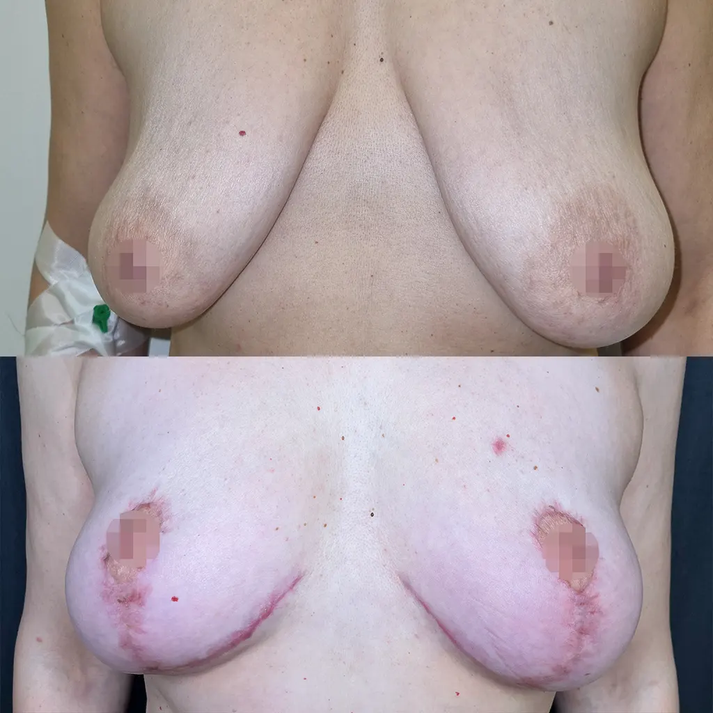 Ανόρθωση Στήθους μέσα από αληθινές φωτογραφίες Πριν και Μετά