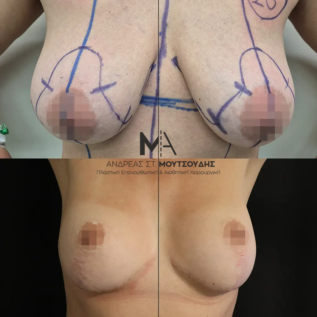 Ανόρθωση Στήθους μέσα από αληθινές φωτογραφίες Πριν και Μετά