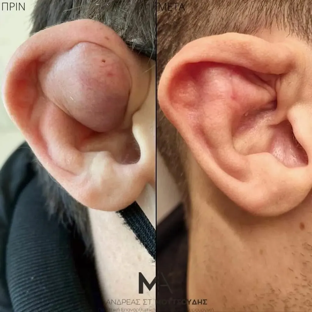 Αποκατάσταση Χειλοειδών – Ουλών – Τραυμάτων μέσα από αληθινές φωτογραφίες Πριν και Μετά