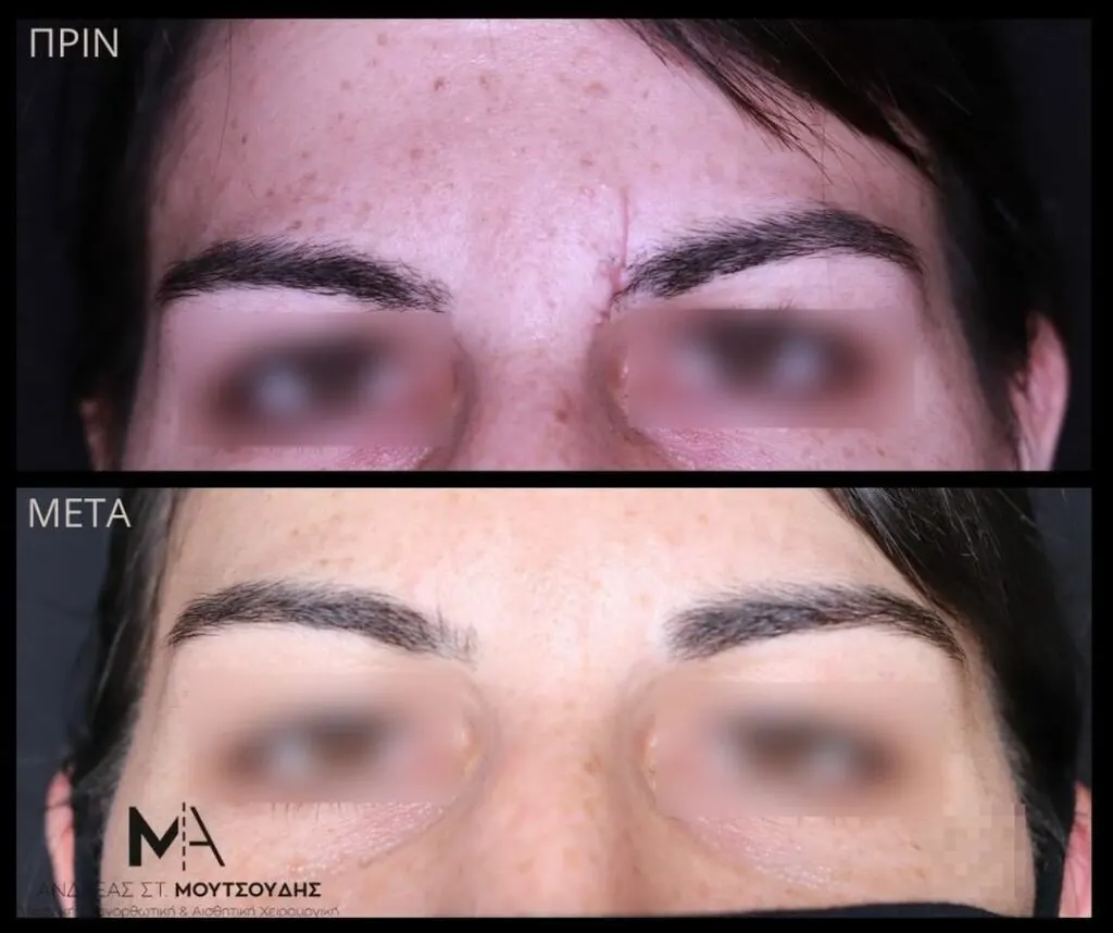 Αποκατάσταση Χειλοειδών – Ουλών – Τραυμάτων μέσα από αληθινές φωτογραφίες Πριν και Μετά