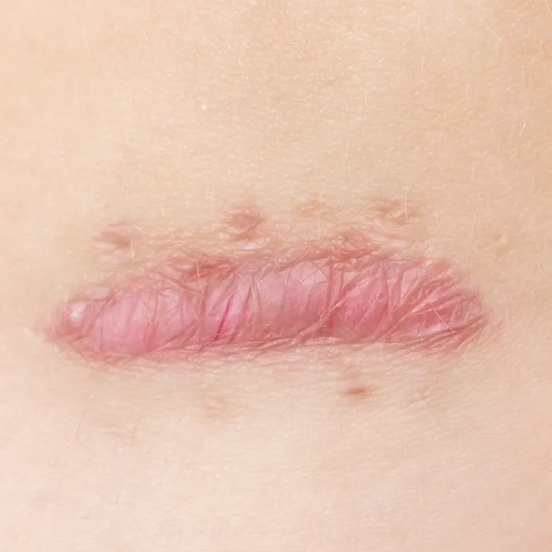 Αποκατάσταση Χειλοειδών – Ουλών – Τραυμάτων