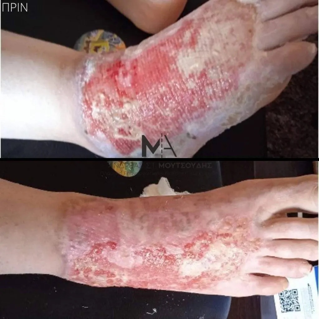 Αποκατάσταση Εγκαύματος μέσα από αληθινές φωτογραφίες Πριν και Μετά