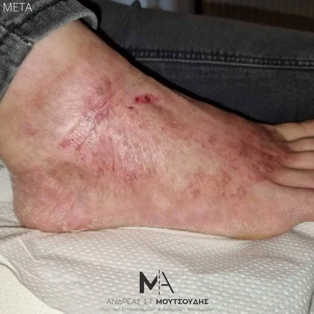 Αποκατάσταση Εγκαύματος μέσα από αληθινές φωτογραφίες Πριν και Μετά