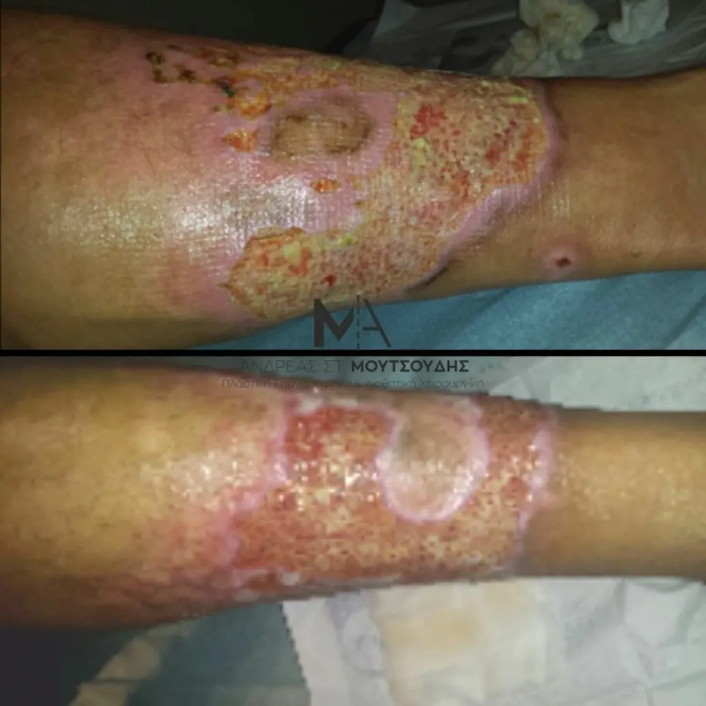 Αποκατάσταση Εγκαύματος μέσα από αληθινές φωτογραφίες Πριν και Μετά