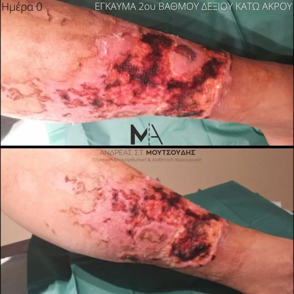 Αποκατάσταση Εγκαύματος μέσα από αληθινές φωτογραφίες Πριν και Μετά