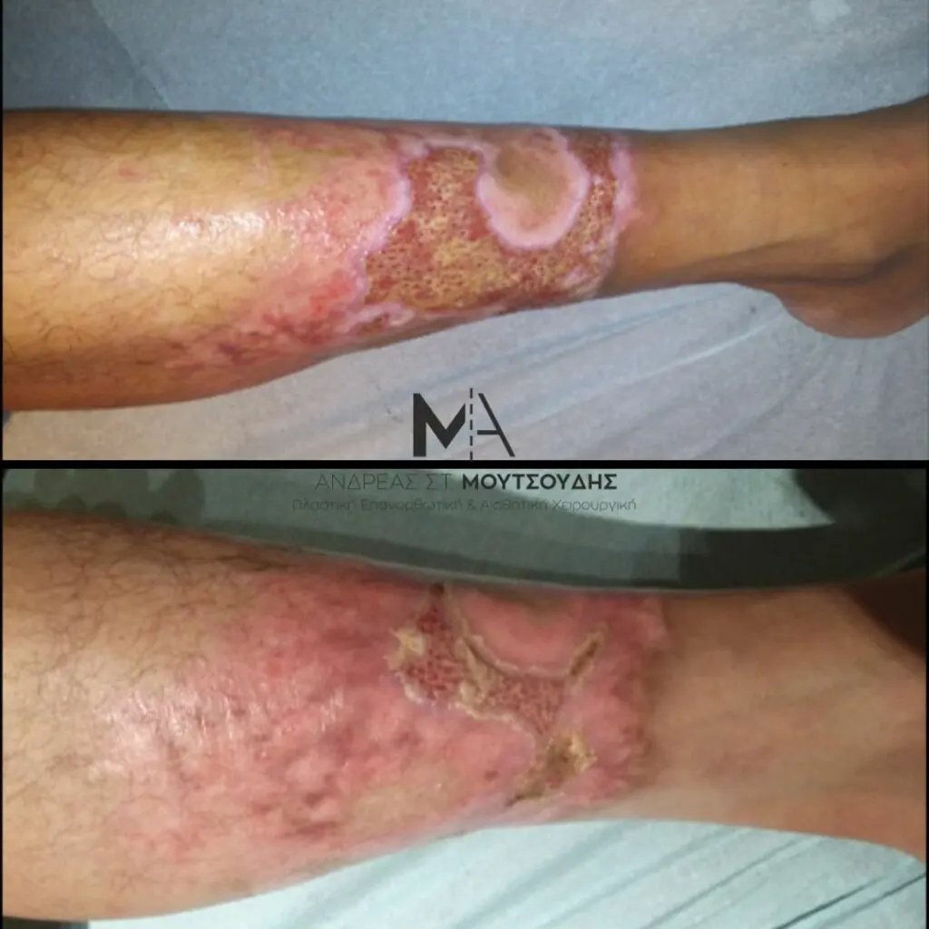 Αποκατάσταση Εγκαύματος μέσα από αληθινές φωτογραφίες Πριν και Μετά