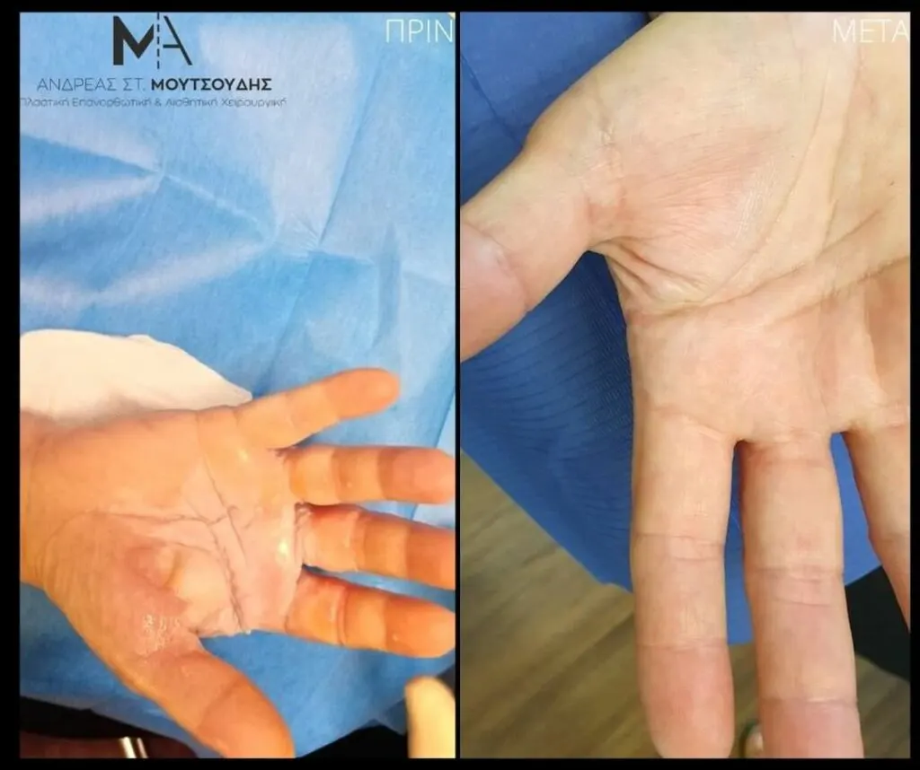 Αποκατάσταση Εγκαύματος μέσα από αληθινές φωτογραφίες Πριν και Μετά