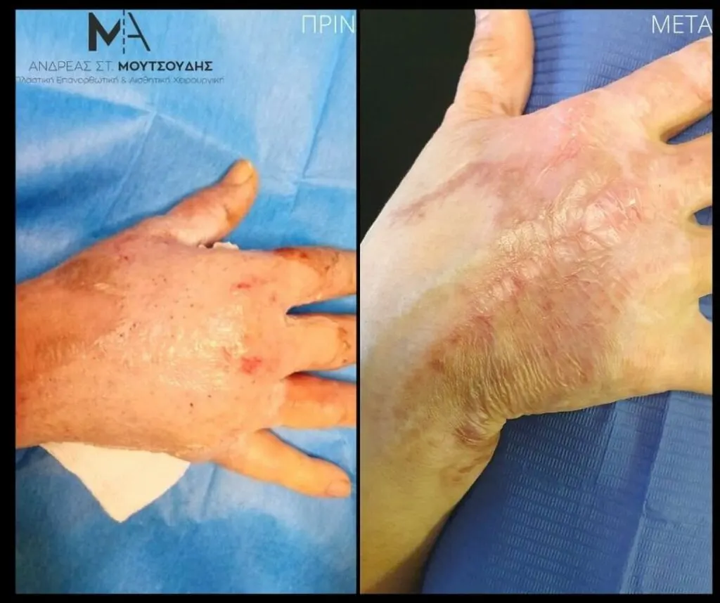 Αποκατάσταση Εγκαύματος μέσα από αληθινές φωτογραφίες Πριν και Μετά