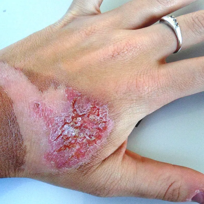 Αποκατάσταση Εγκαύματος