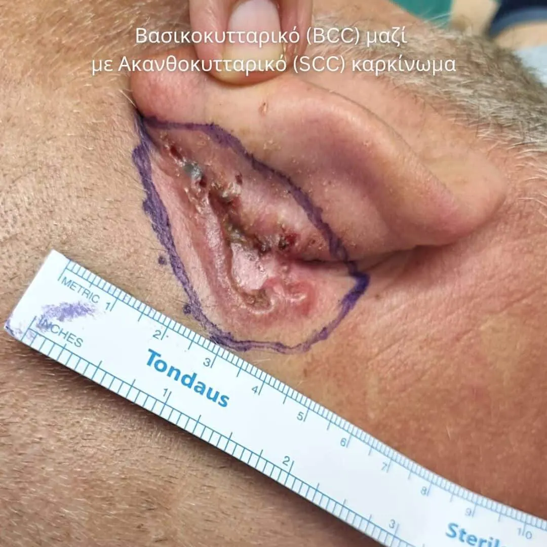 Αποκατάσταση Όγκων Δέρματος Πριν και Μετά