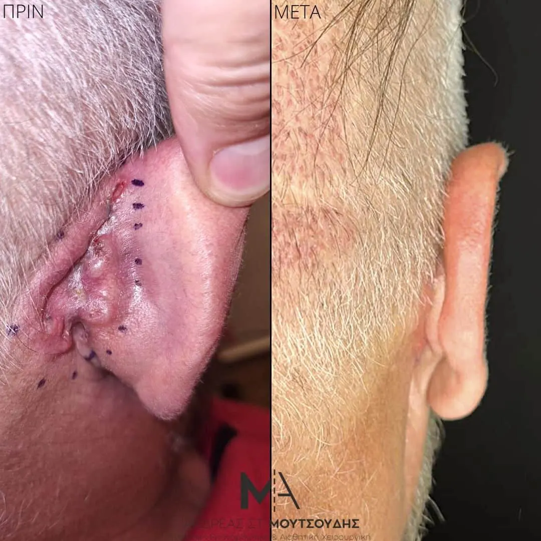 Αποκατάσταση Όγκων Δέρματος Πριν και Μετά