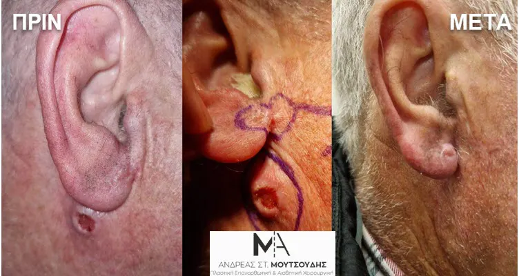 Αποκατάσταση Όγκων Δέρματος Πριν και Μετά