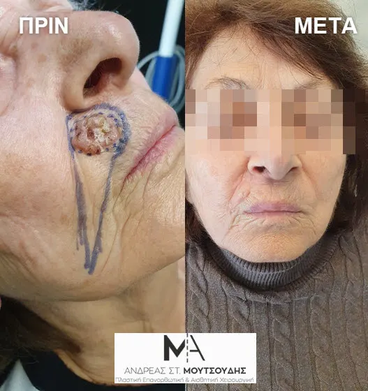 Αποκατάσταση Όγκων Δέρματος Πριν και Μετά