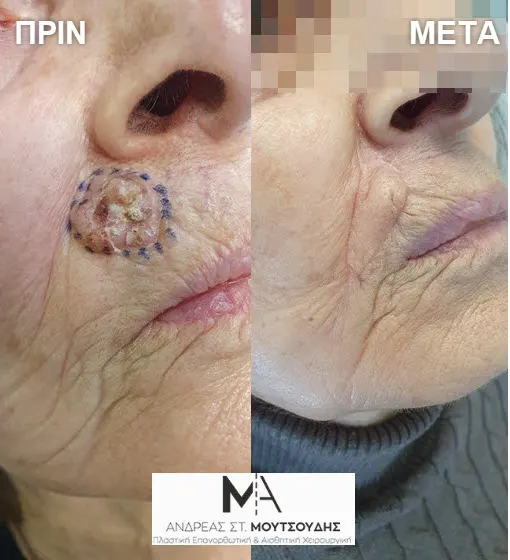 Αποκατάσταση Όγκων Δέρματος Πριν και Μετά