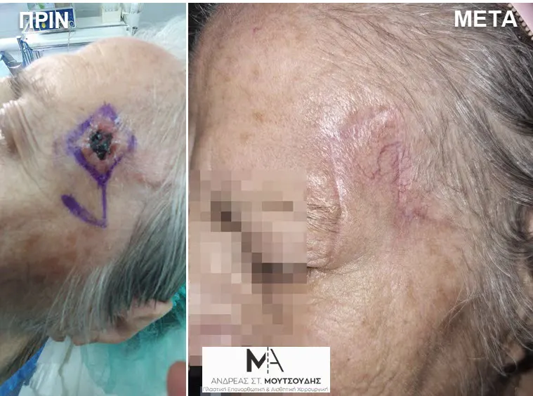Αποκατάσταση Όγκων Δέρματος Πριν και Μετά