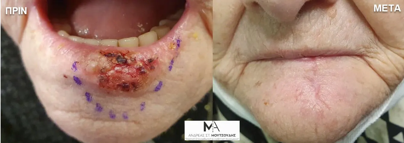 Αποκατάσταση Όγκων Δέρματος Πριν και Μετά