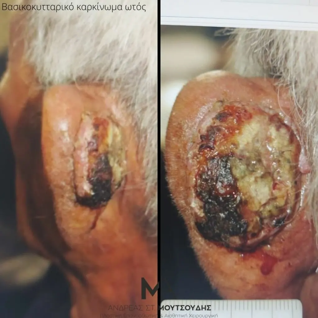 Αποκατάσταση Όγκων Δέρματος Πριν και Μετά