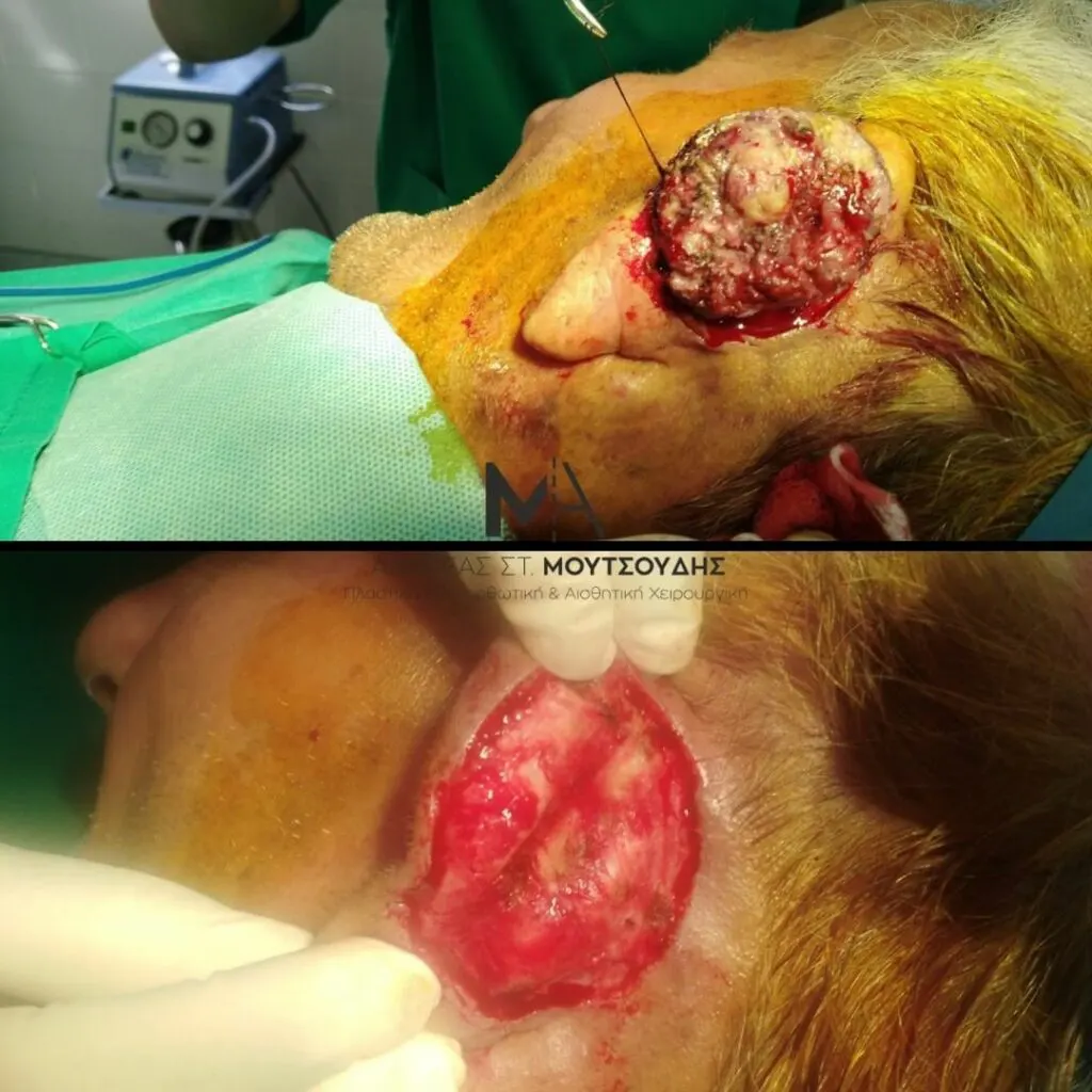 Αποκατάσταση Όγκων Δέρματος Πριν και Μετά