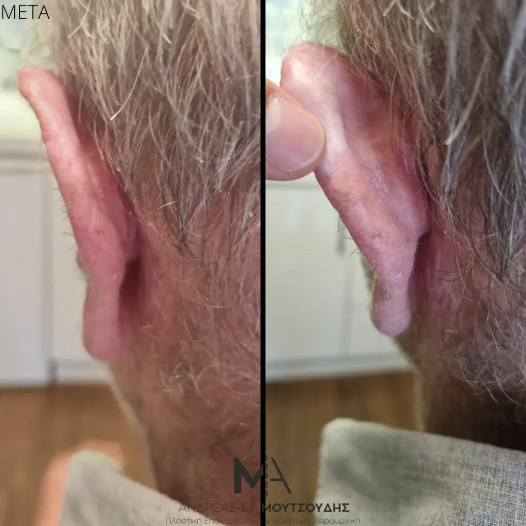 Αποκατάσταση Όγκων Δέρματος Πριν και Μετά