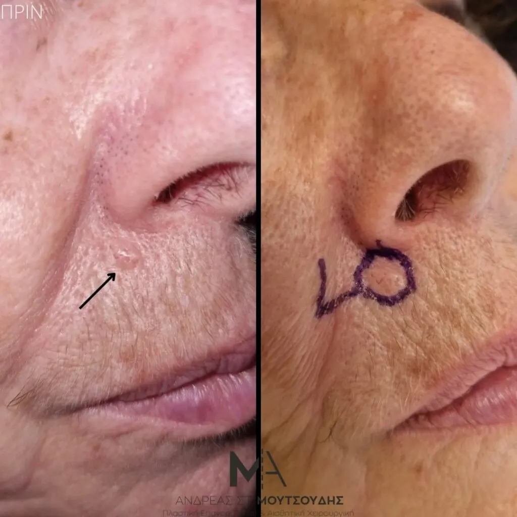 Αποκατάσταση Όγκων Δέρματος Πριν και Μετά