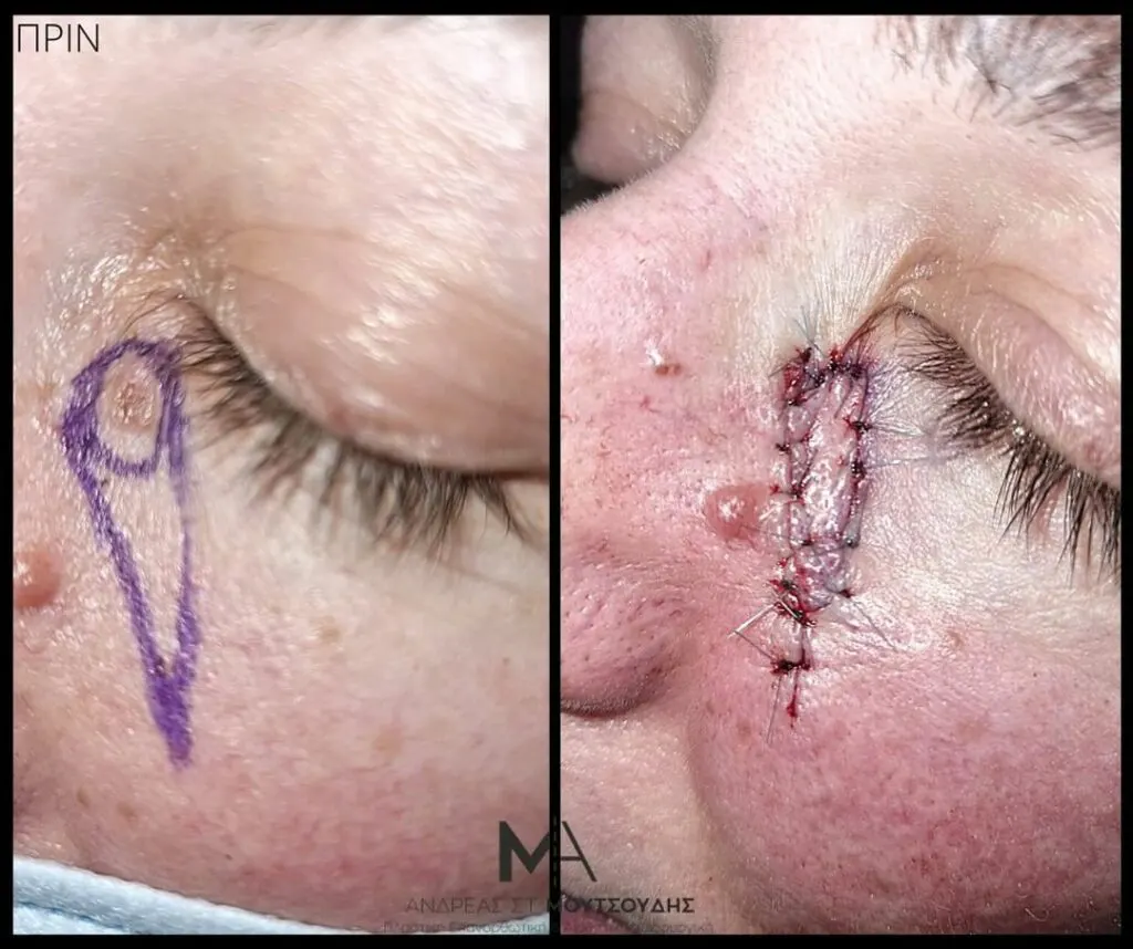Αποκατάσταση Όγκων Δέρματος Πριν και Μετά