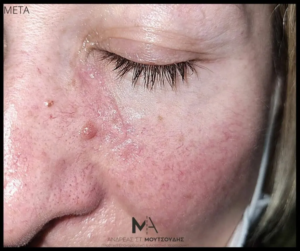 Αποκατάσταση Όγκων Δέρματος Πριν και Μετά