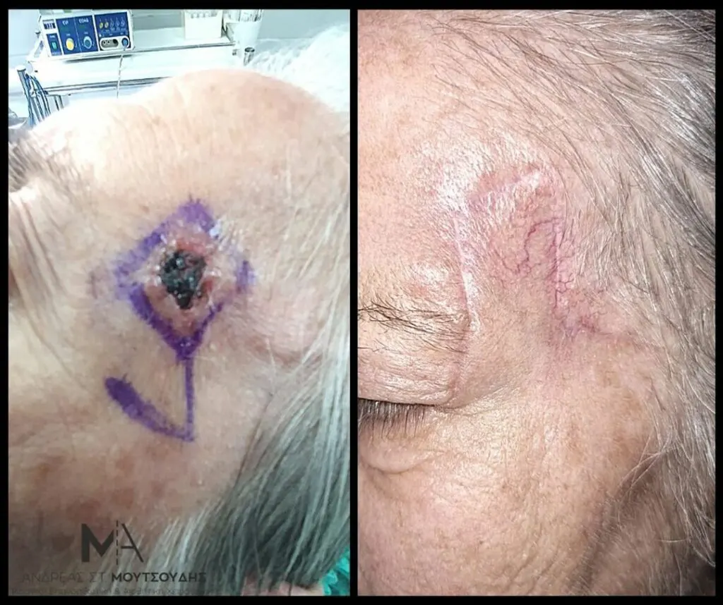 Αποκατάσταση Όγκων Δέρματος Πριν και Μετά