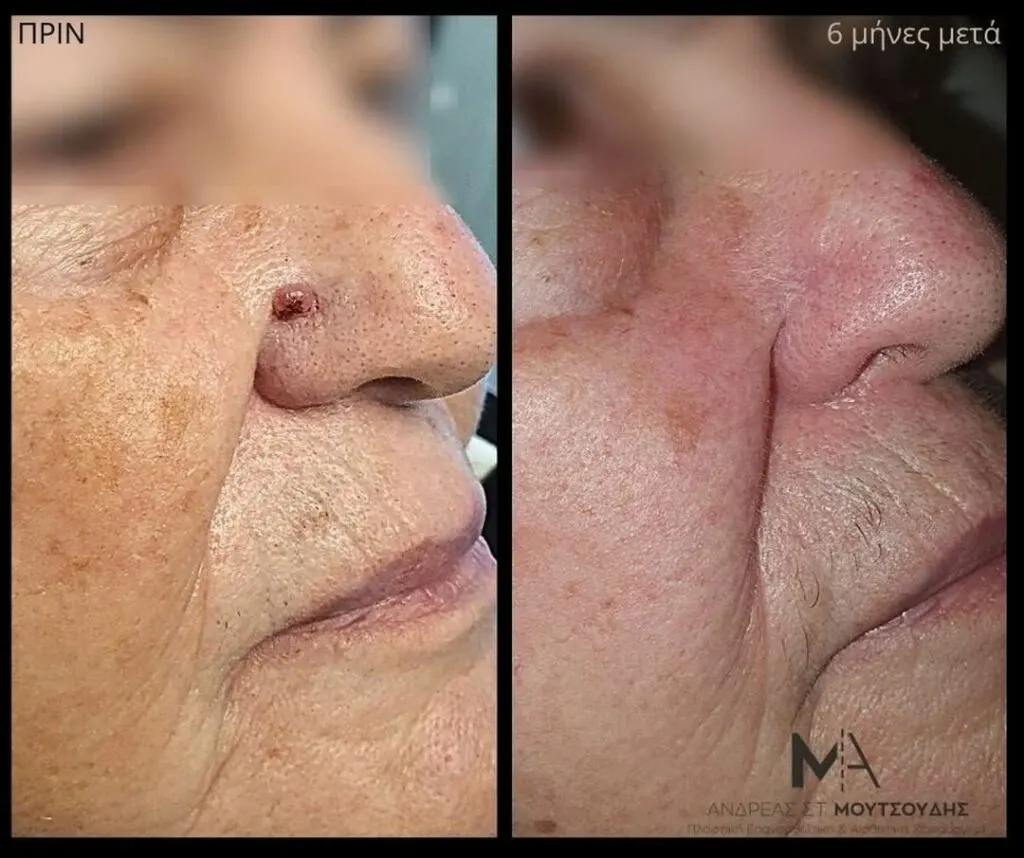 Αποκατάσταση Όγκων Δέρματος Πριν και Μετά