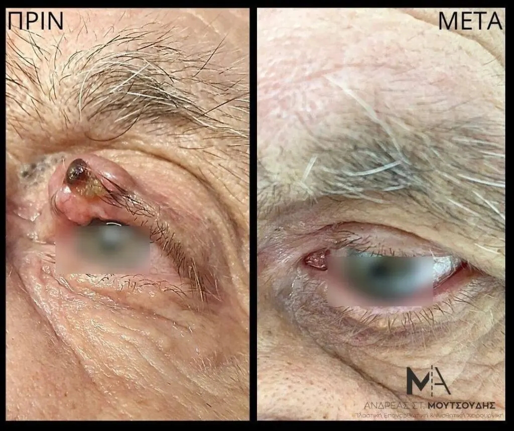 Αποκατάσταση Όγκων Δέρματος Πριν και Μετά