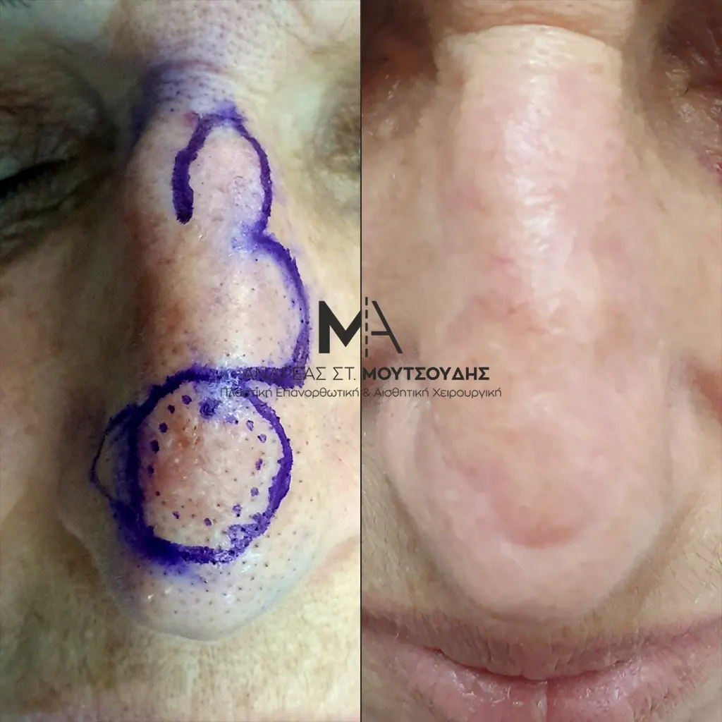 Αποκατάσταση Όγκων Δέρματος Πριν και Μετά