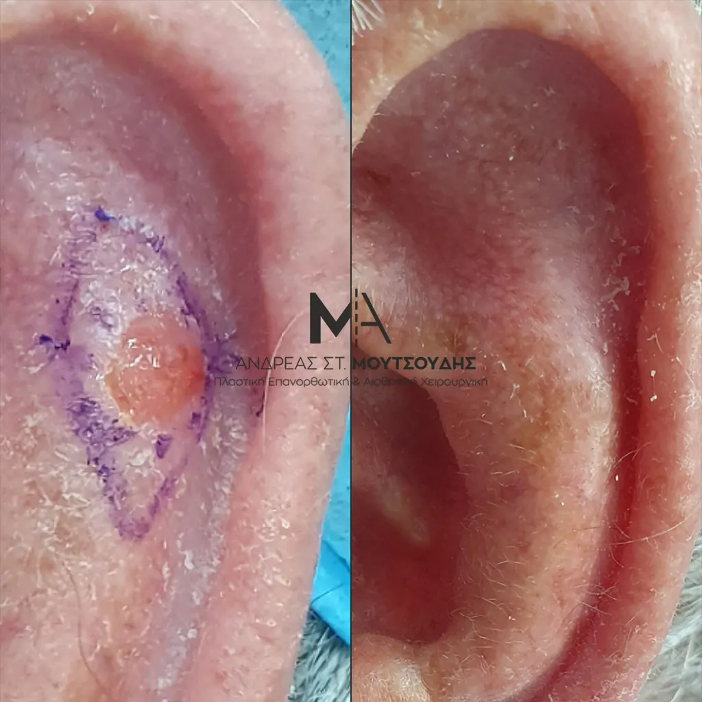 Αποκατάσταση Όγκων Δέρματος Πριν και Μετά