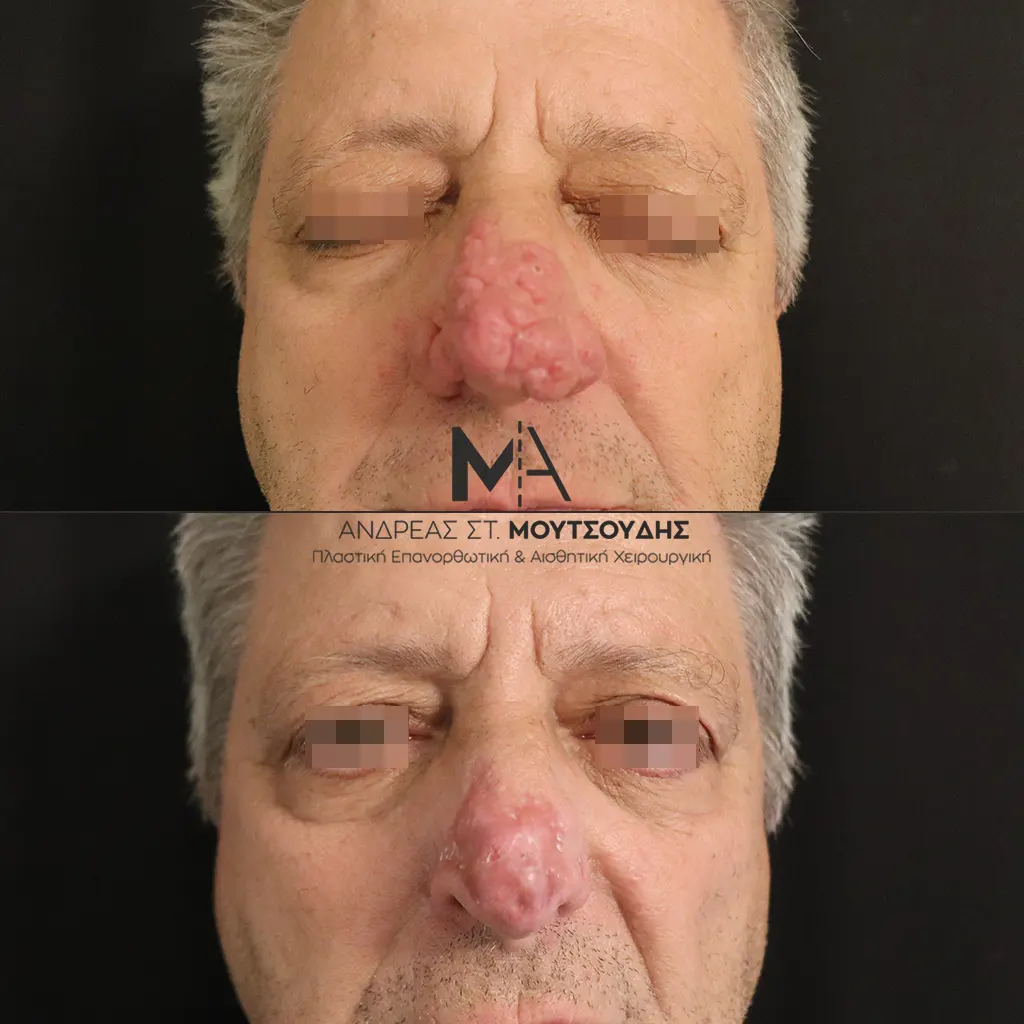 Αποκατάσταση Όγκων Δέρματος Πριν και Μετά