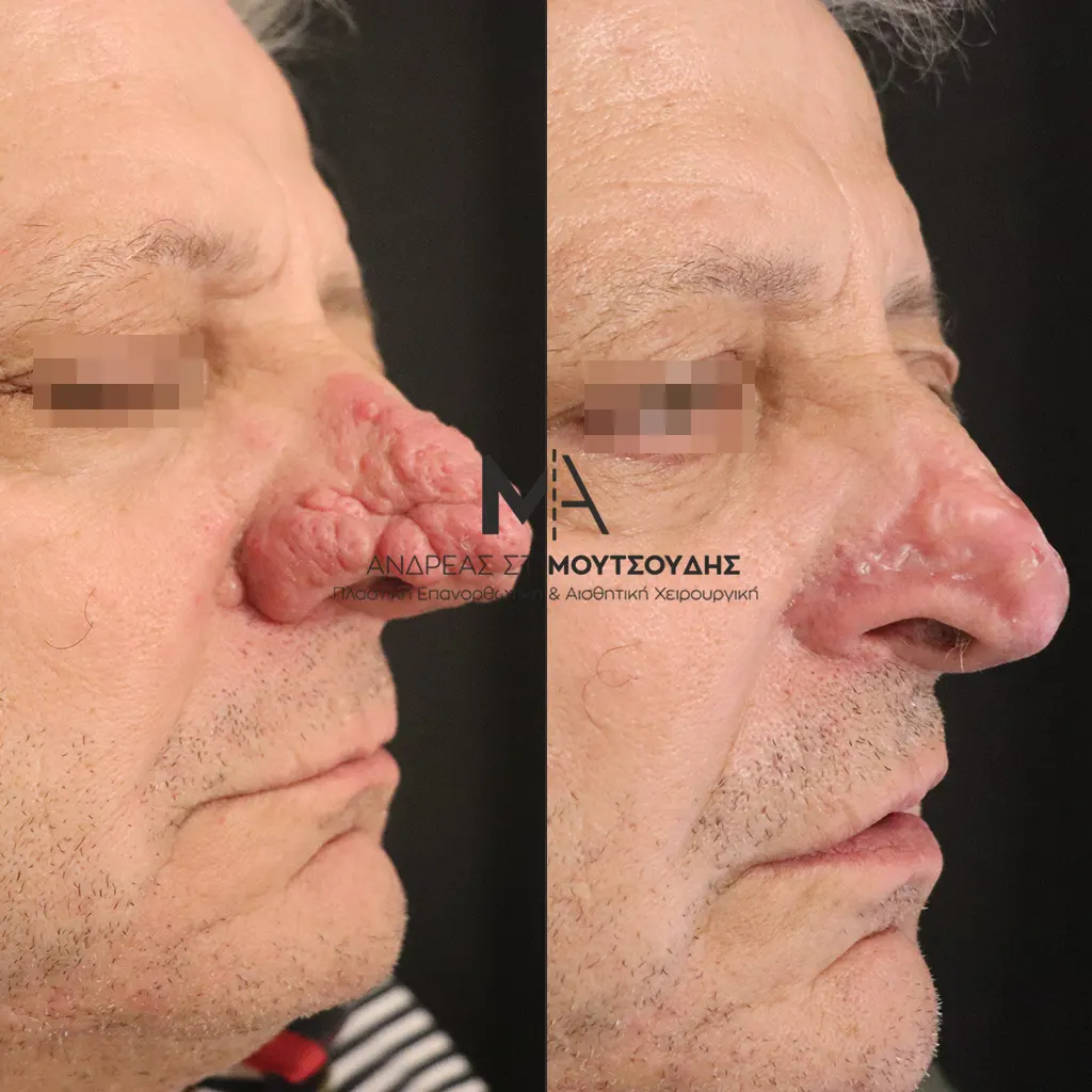 Αποκατάσταση Όγκων Δέρματος Πριν και Μετά