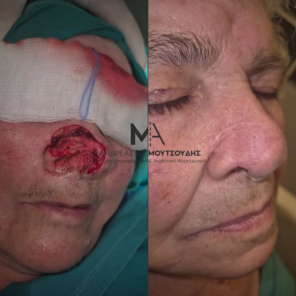 Αποκατάσταση Όγκων Δέρματος Πριν και Μετά