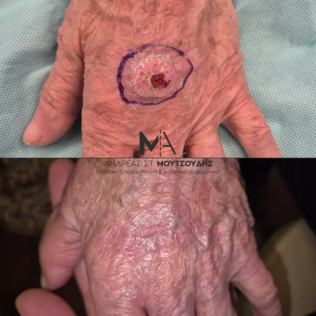 Αποκατάσταση Όγκων Δέρματος Πριν και Μετά