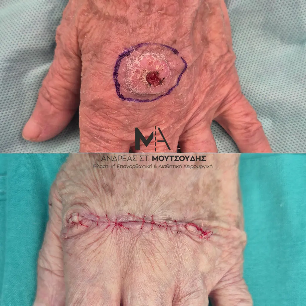 Αποκατάσταση Όγκων Δέρματος Πριν και Μετά