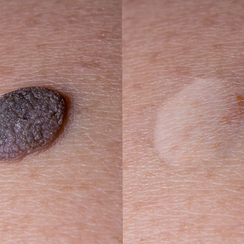 Αποκατάσταση όγκων δέρματος