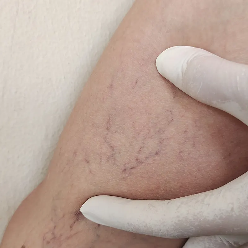 Ευρυαγγείες