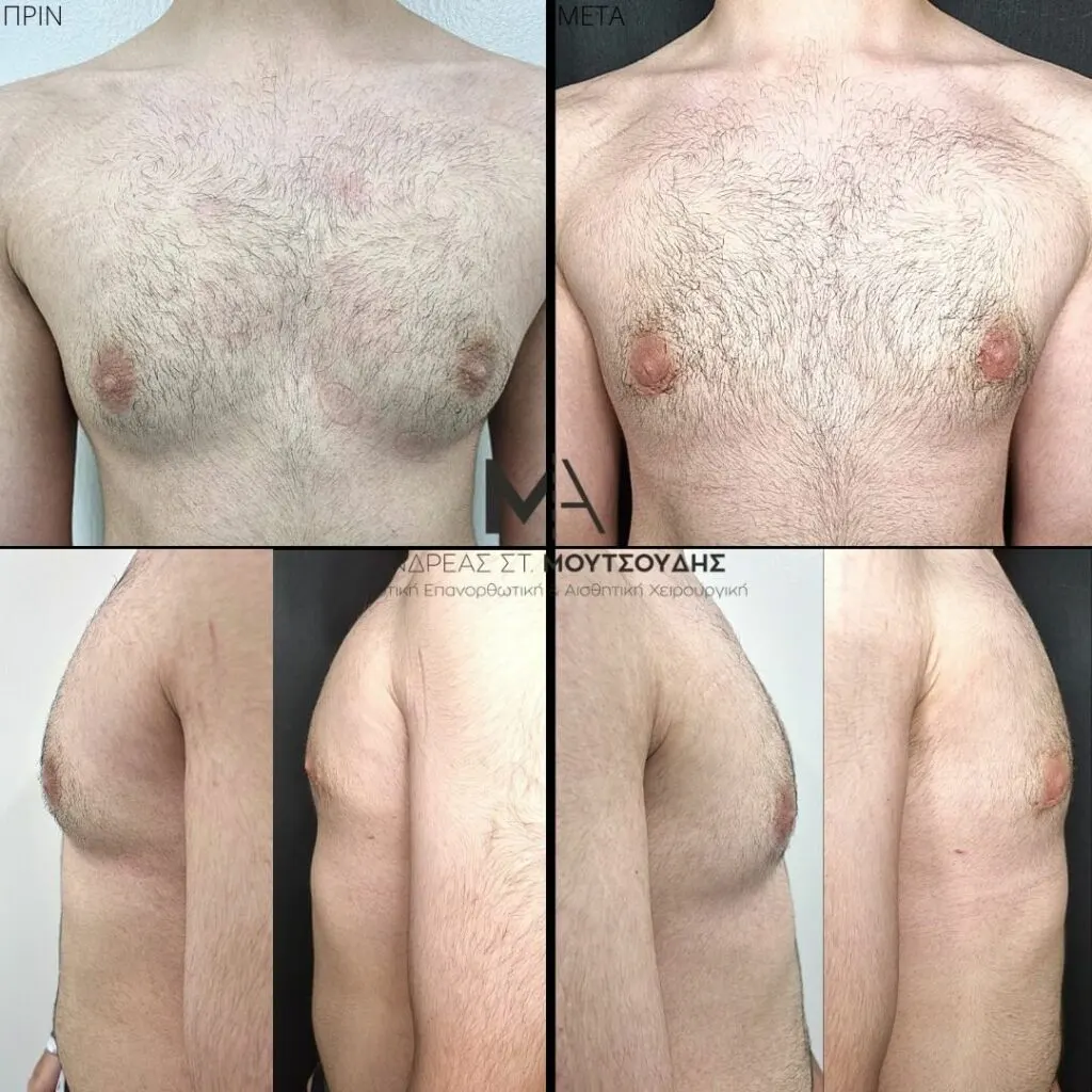 Γυναικομαστία Πριν και Μετά