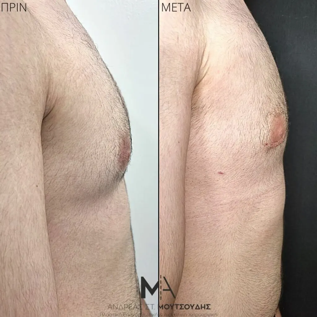 Γυναικομαστία Πριν και Μετά