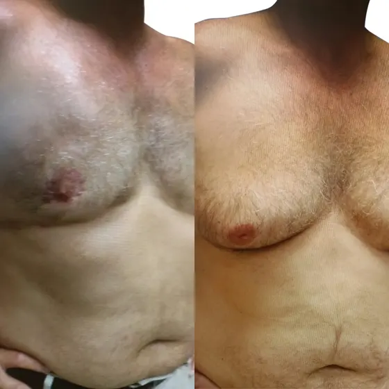 Γυναικομαστία Πριν και Μετά