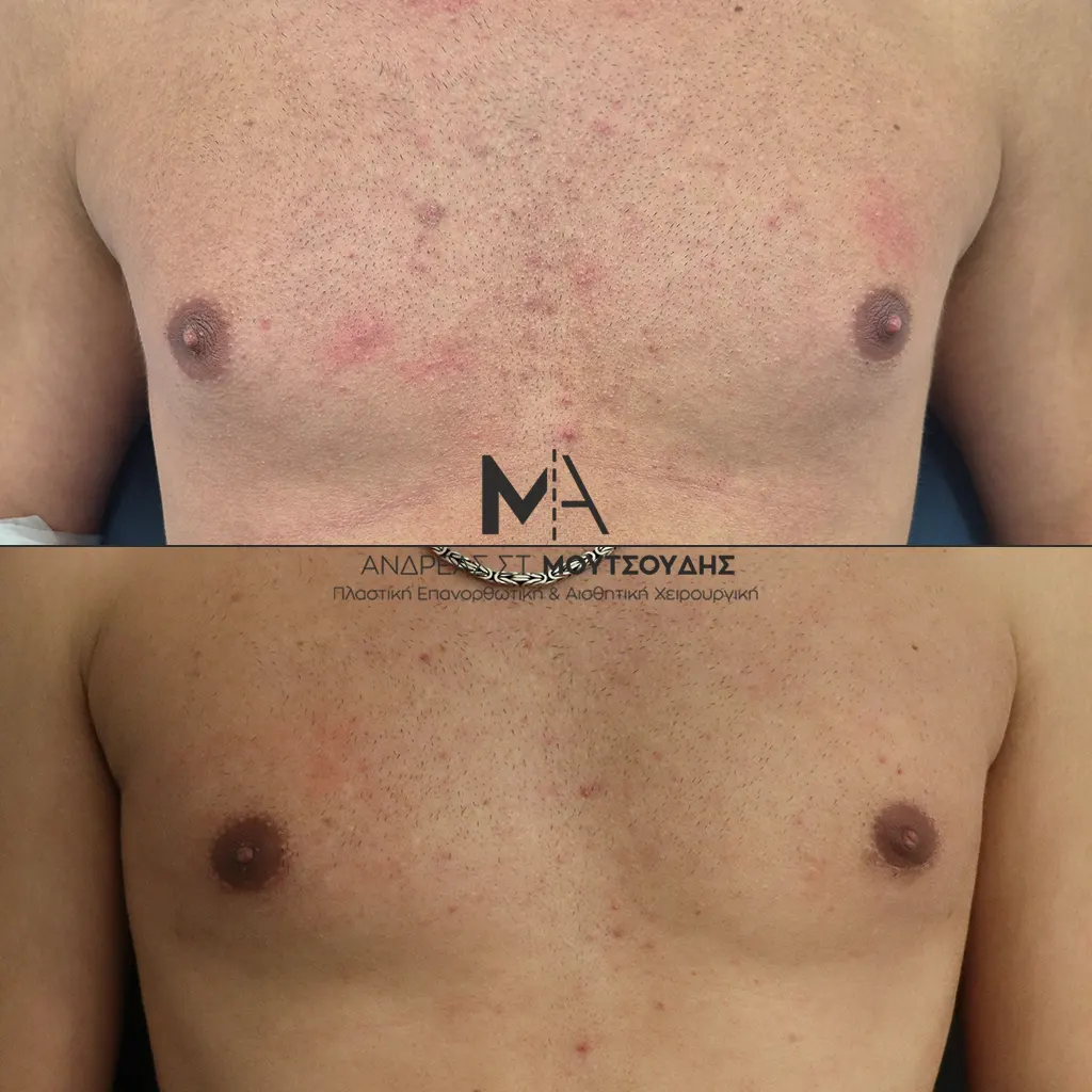 Γυναικομαστία Πριν και Μετά