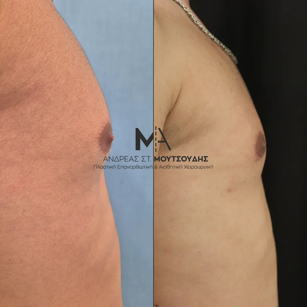 Γυναικομαστία Πριν και Μετά