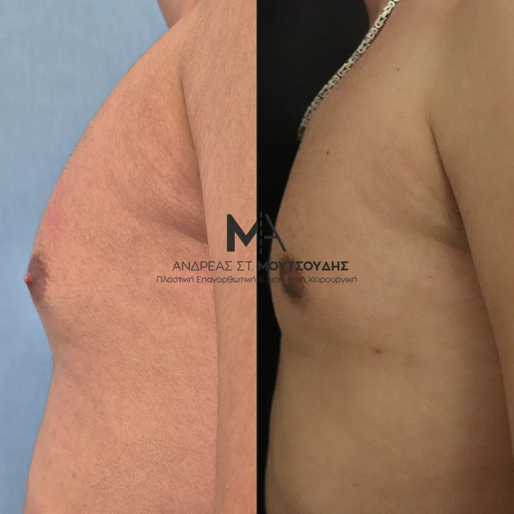 Γυναικομαστία Πριν και Μετά