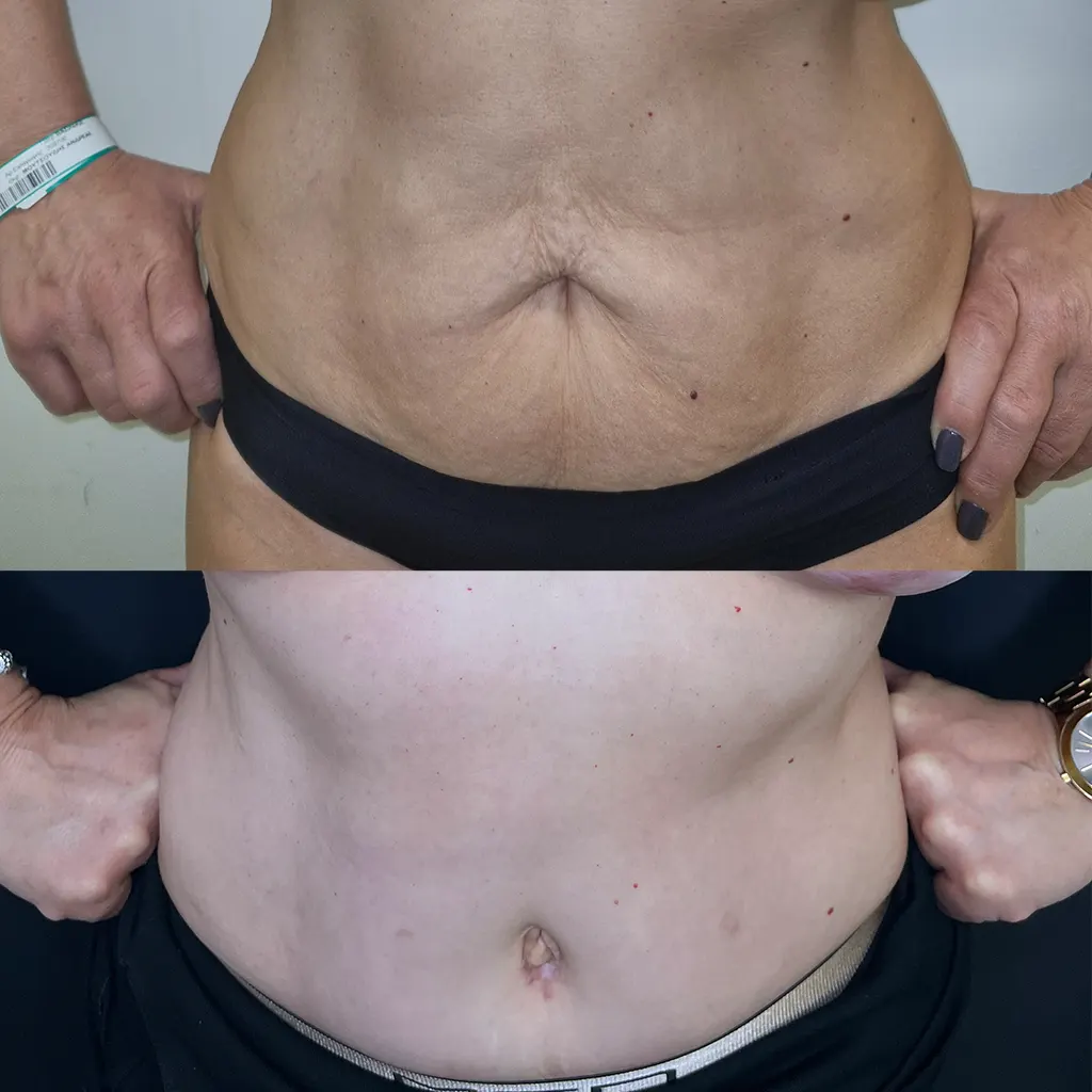 Κοιλιοπλαστική – Πλαστική Κοιλιάς μέσα από αληθινές φωτογραφίες Πριν και Μετά